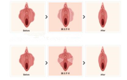 小阴唇整形手术过程