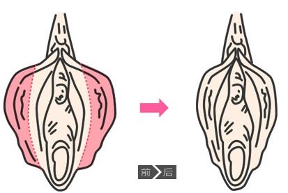 小阴唇整形卡通对比示意