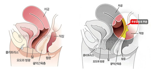 好手艺私密整形医院阴道紧缩术示意图