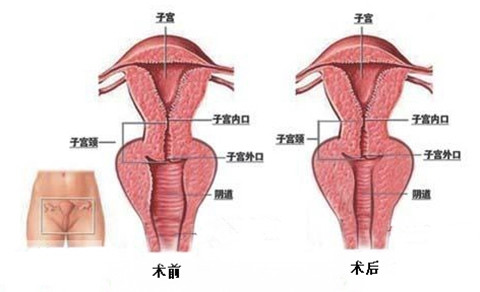 阴道紧缩术示意