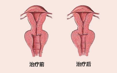 阴道紧缩术示意对比图