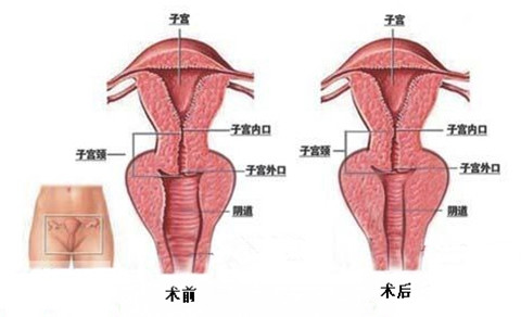阴道紧缩术示意图