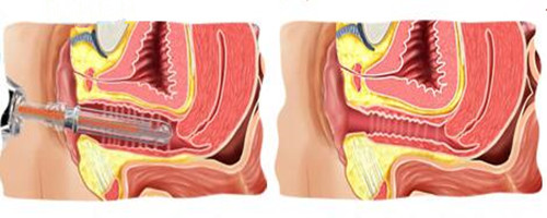 激光阴道紧缩术示意图
