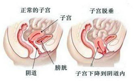 子宫下垂至阴道内示意图