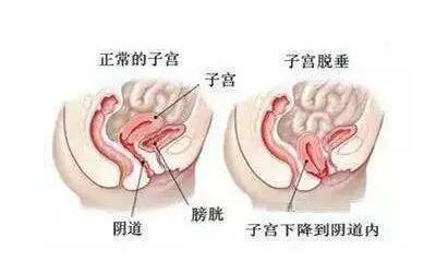 正常子宫下垂的情况