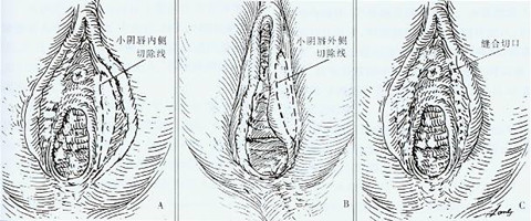 小阴唇整形过程