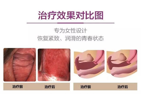 后方膣圆盖术手术效果图