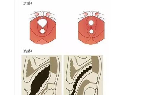 阴道紧缩术效果图