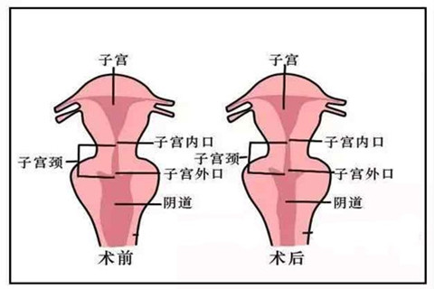 后方膣圆盖术手术对比照.jpg