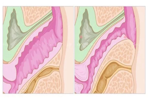阴道紧缩手术对比图.jpg