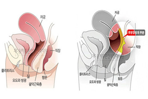 后方膣圆盖术示意图.jpg