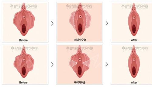 韩国好手艺小阴唇缩小术