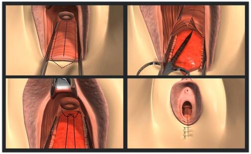 后方膣圆盖术手术过程