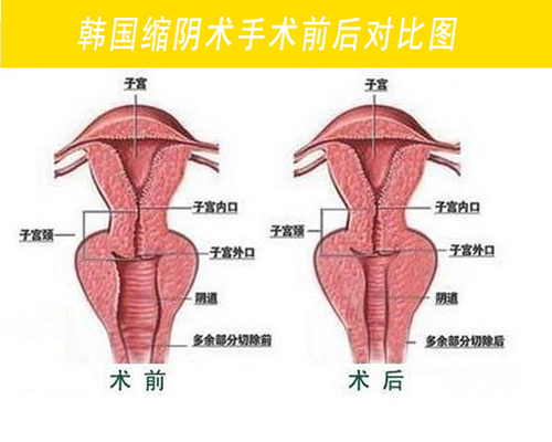 阴道松弛对比