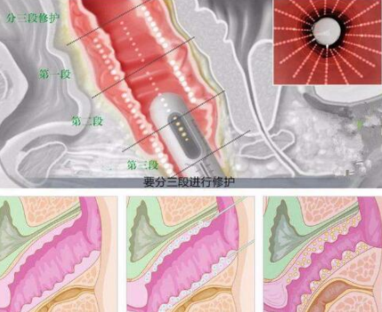 激光紧缩阴道