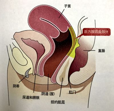 后方膣圆盖术图