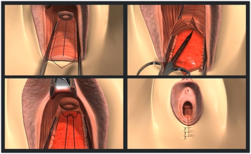 后方膣圆盖缩阴手术