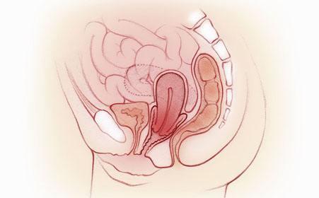 子宫下垂症状自检