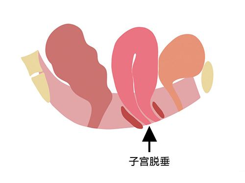 怎样知道子宫下垂了