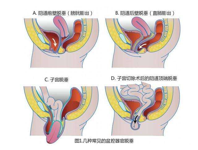 产后子宫下垂