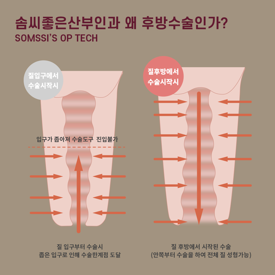 后方膣圆盖术缩阴