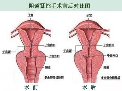 阴道紧缩术会反弹吗