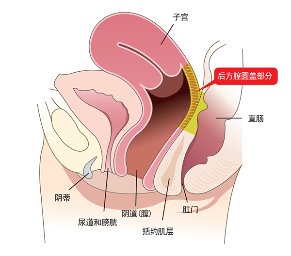 后方膣圆盖术和其他缩阴手术的区别