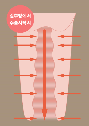为什么韩国好手艺给我做的缩阴手术里面比阴道口紧？