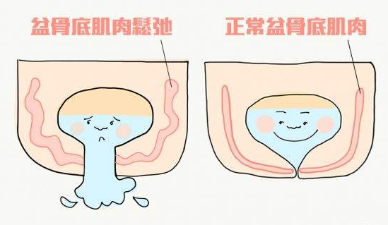 盆底肌松弛后导致肌肉无力