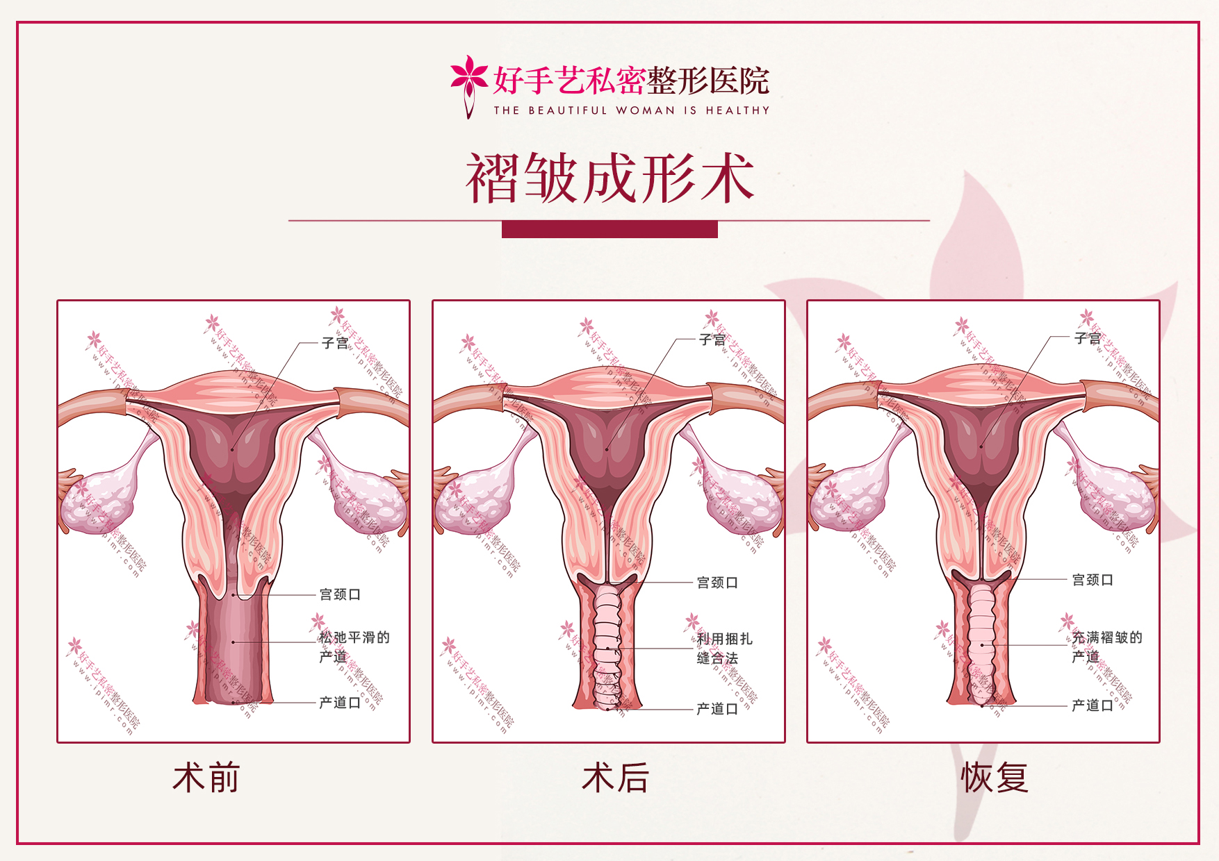 产道褶皱成形术.jpg