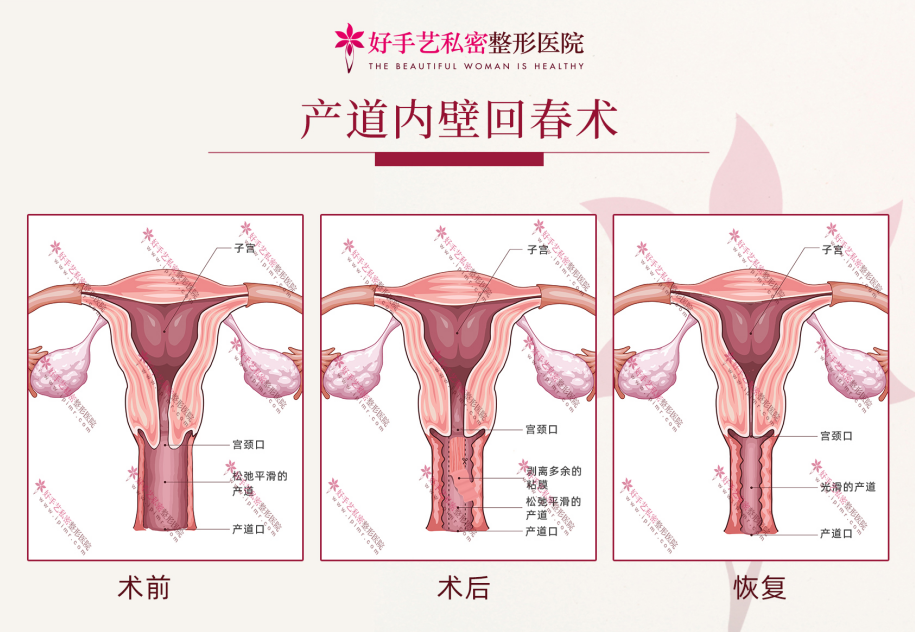 产道内壁回春术方式是什么？