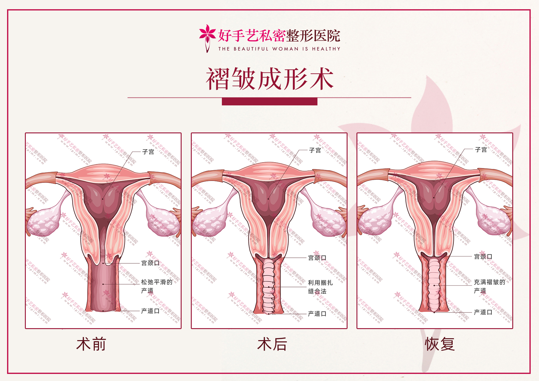 为什么生完孩子后需要做产道褶皱成形术？