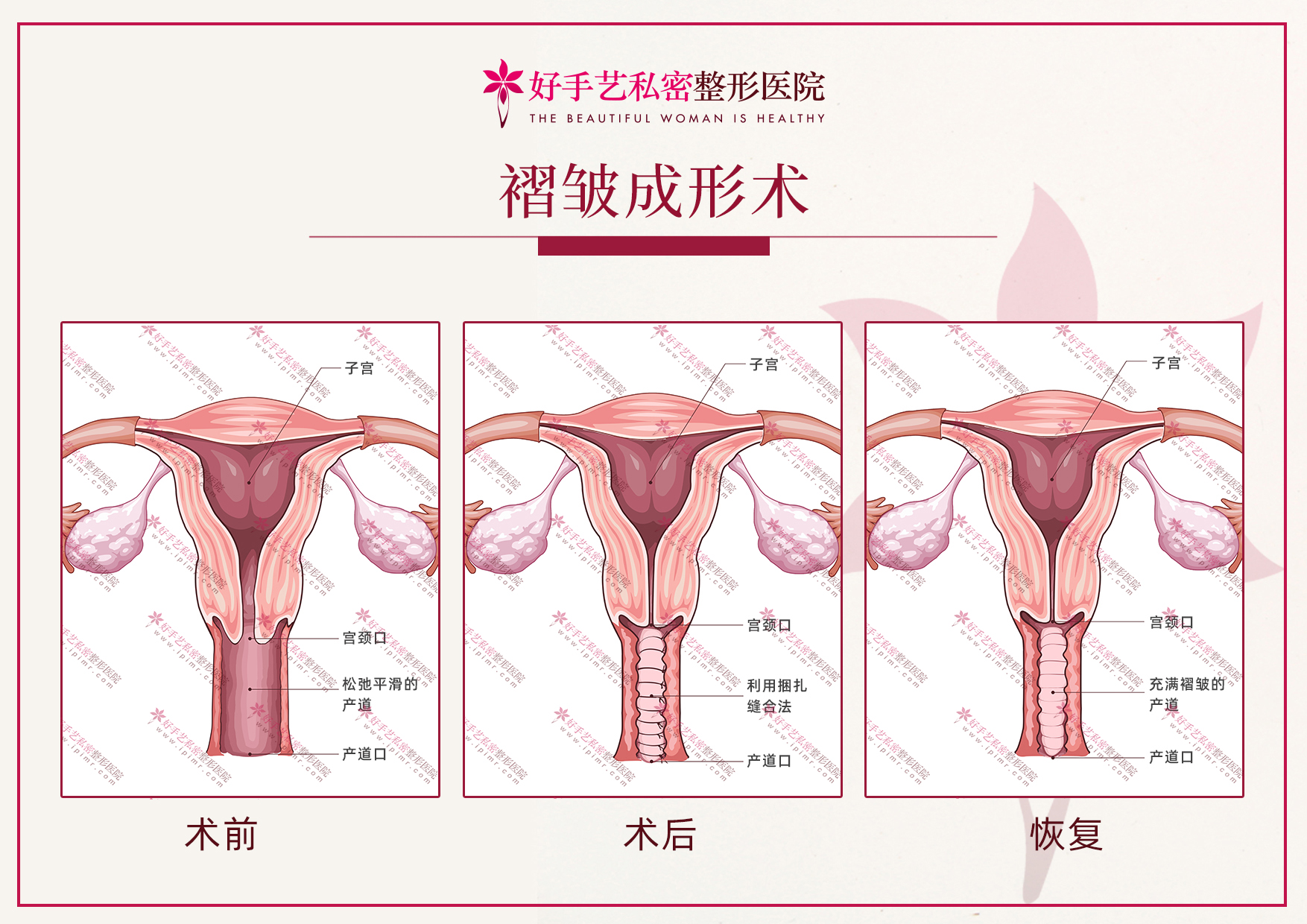 韩国好手艺妇科医院产道褶皱成形术