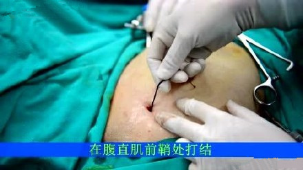 腹腔镜下子宫悬吊术