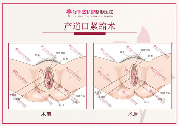 产道口紧缩术