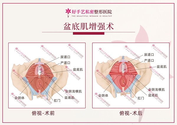 盆底肌增强术