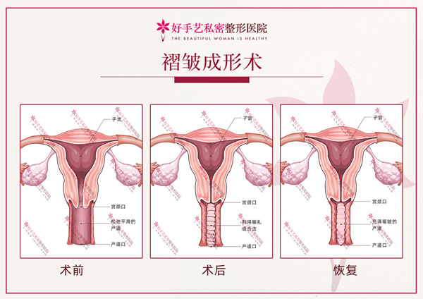 褶皱成形术