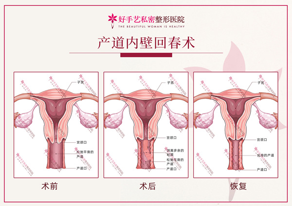 韩国好手艺私密整形缩阴过程