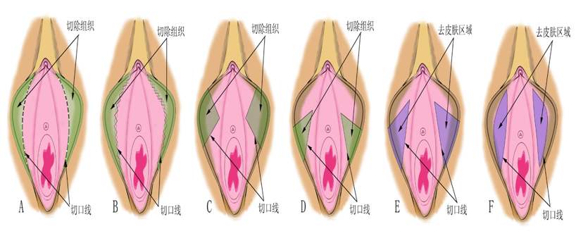 小阴唇肥大手术方案
