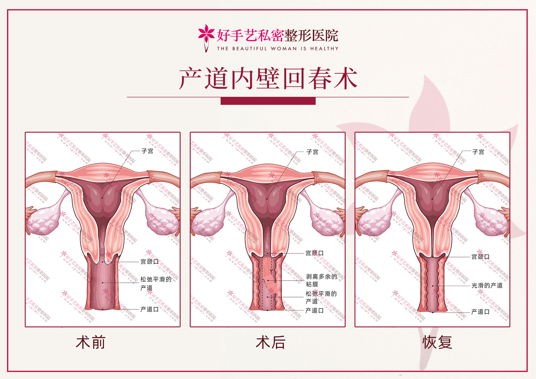 好手艺妇科医院产道内壁回春术