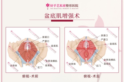 尹虎珠院长的盆底肌增强修复术