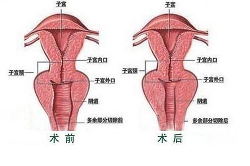 阴部紧致对比图