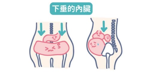 好手艺妇科下垂的盆腔脏器