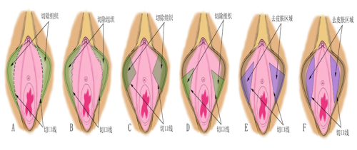 小阴唇手术