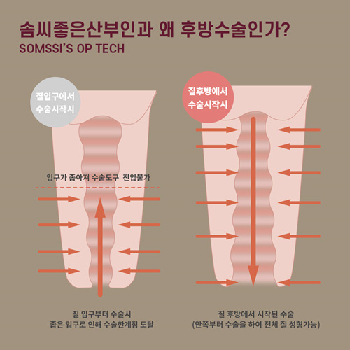 韩国尹虎珠院长缩阴手术特色