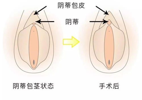 阴蒂包皮过长手术前后