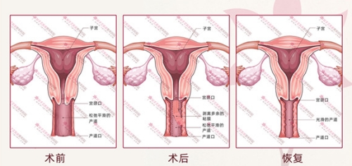 尹虎珠院长的缩阴结果