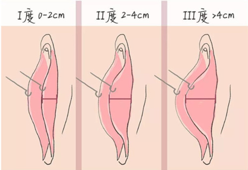 小阴唇肥厚等级