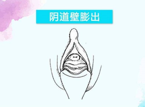 阴道壁膨出