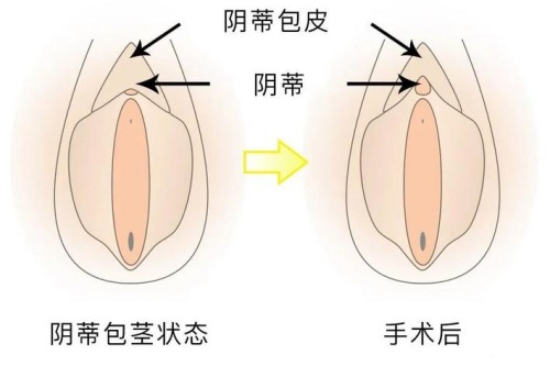 阴蒂包皮过长手术前后
